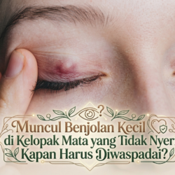 Muncul Benjolan Kecil di Kelopak Mata yang Tidak Nyeri, Kapan Harus Diwaspadai?